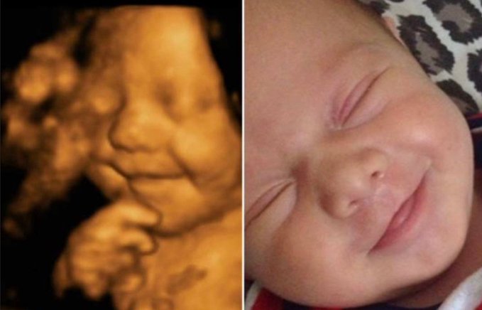 Ultrasoundsmile4